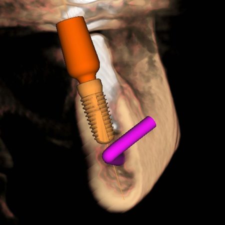 Implantate - Knochenaufbau